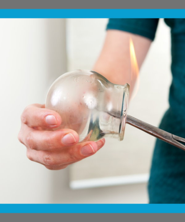 Fire cupping at The Therapy Venue