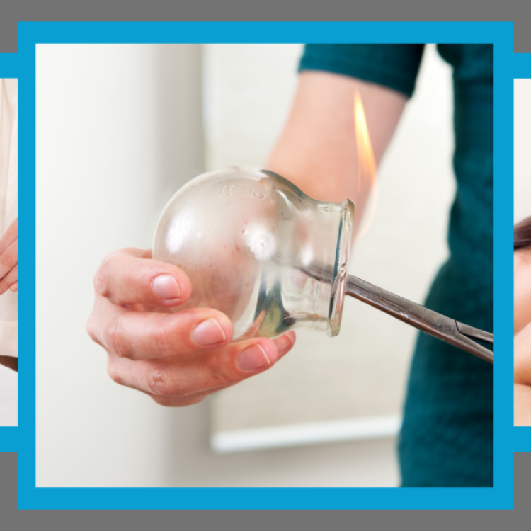 Fire cupping at The Therapy Venue